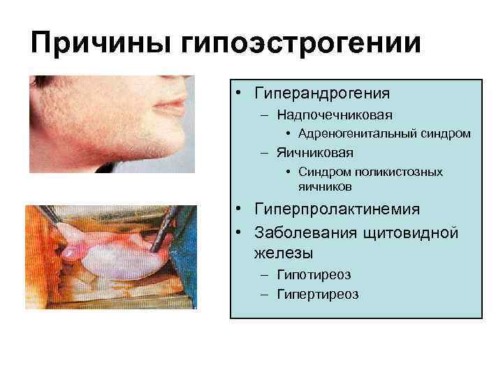 Для клинической картины гиперандрогении надпочечникового генеза характерно