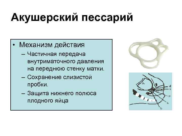 Какое кольцо ставят для сохранения беременности фото