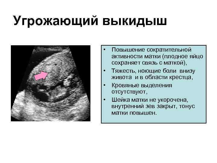 Угрожающий выкидыш • Повышение сократительной активности матки (плодное яйцо сохраняет связь с маткой), •