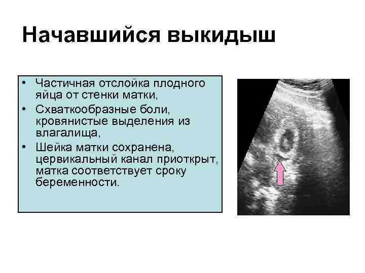 Картинки Выкидыша На 6 Неделе