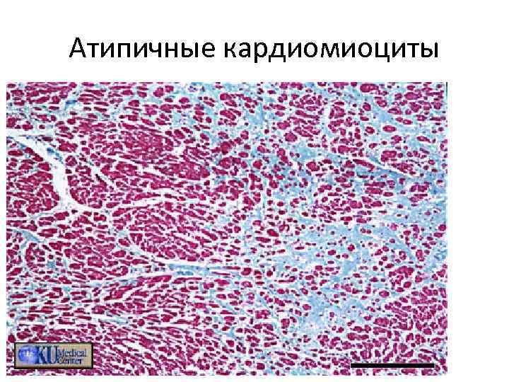 Атипичные кардиомиоциты рисунок