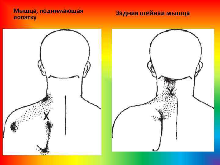 Мышца, поднимающая лопатку Задняя шейная мышца 