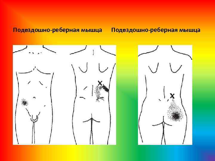 Подвздошно-реберная мышца 