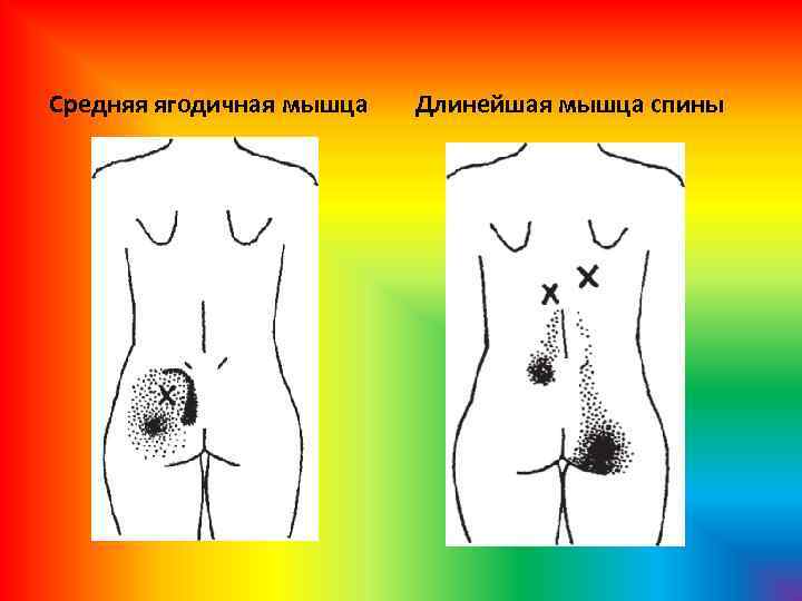 Средняя ягодичная мышца Длинейшая мышца спины 