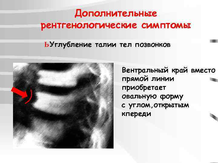 Дополнительные рентгенологические симптомы ь Углубление талии тел позвонков Вентральный край вместо прямой линии приобретает