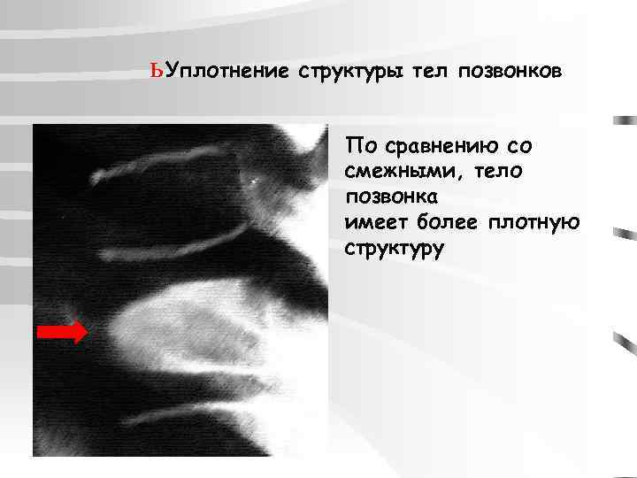 ь Уплотнение структуры тел позвонков По сравнению со смежными, тело позвонка имеет более плотную