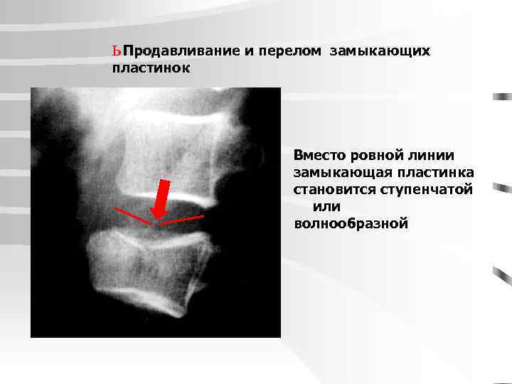 ь Продавливание и перелом пластинок замыкающих Вместо ровной линии замыкающая пластинка становится ступенчатой или