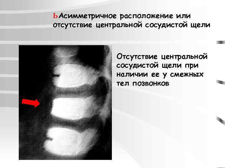 ь Асимметричное расположение или отсутствие центральной сосудистой щели Отсутствие центральной сосудистой щели при наличии