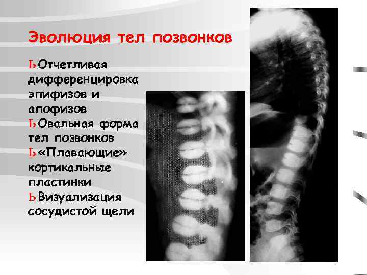 Эволюция тел позвонков ь Отчетливая дифференцировка эпифизов и апофизов ь Овальная форма тел позвонков