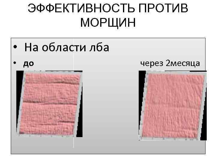 ЭФФЕКТИВНОСТЬ ПРОТИВ МОРЩИН • На области лба • до через 2 месяца 