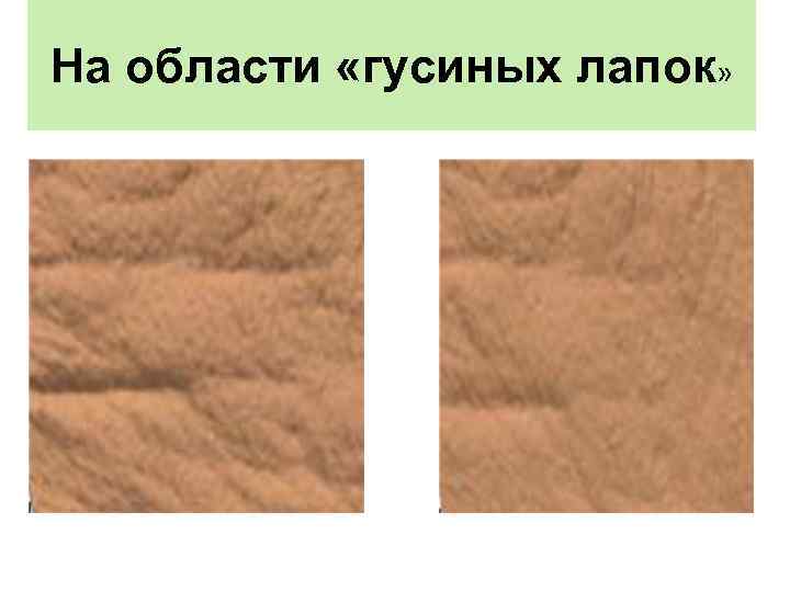 На области «гусиных лапок» 