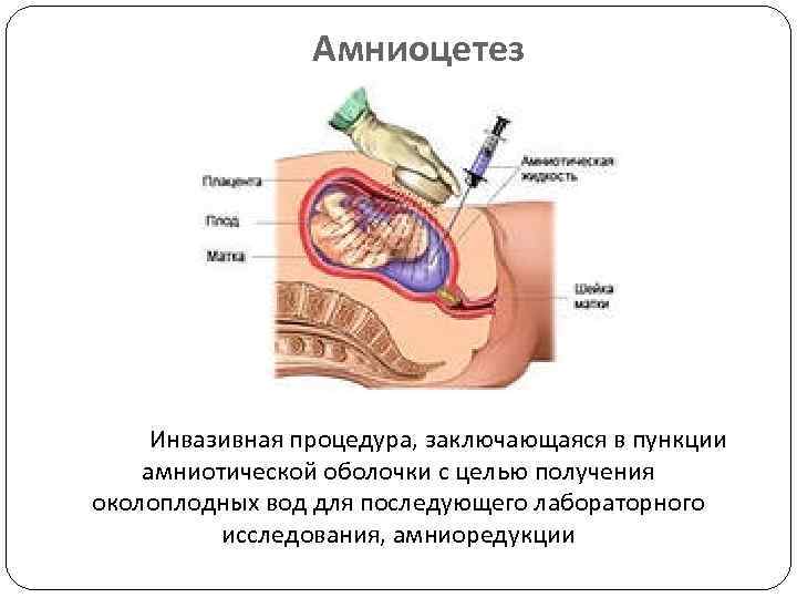 Амниоцетез Инвазивная процедура, заключающаяся в пункции амниотической оболочки с целью получения околоплодных вод для