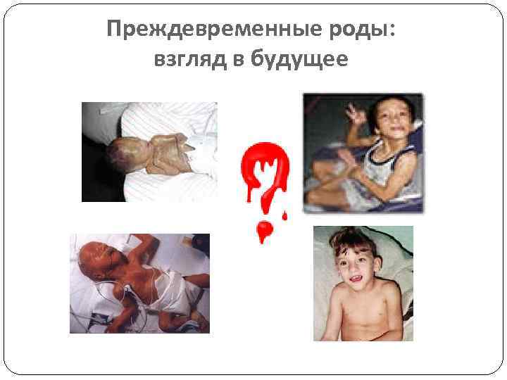 Преждевременные роды: взгляд в будущее 