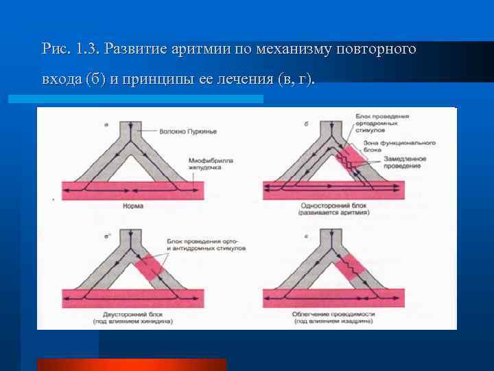 Рис. 1. 3. Развитие аритмии по механизму повторного входа (б) и принципы ее лечения