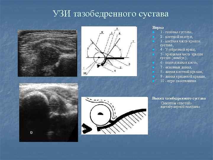 УЗИ тазобедренного сустава Норма n 1 - головка сустава, n 2 - костный выступ,