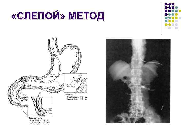  «СЛЕПОЙ» МЕТОД 