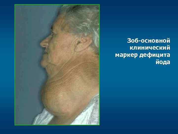 Зоб-основной клинический маркер дефицита йода 