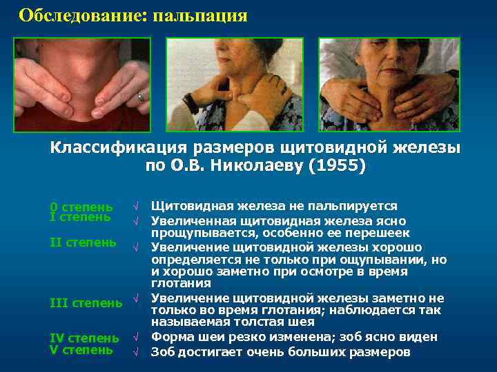 Обследование: пальпация Классификация размеров щитовидной железы по О. В. Николаеву (1955) 0 степень II