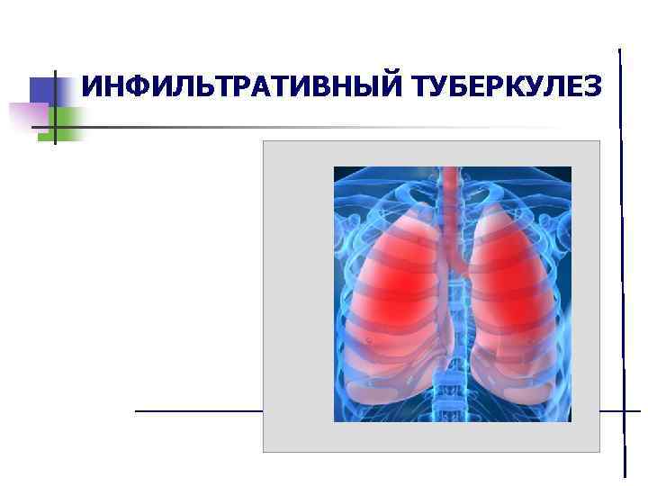 Инфильтративный туберкулез легких презентация