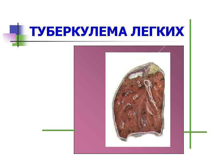 Клиническая картина туберкулеза