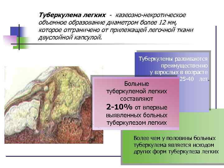 Туберкулема легких - казеозно-некротическое объемное образование диаметром более 12 мм, которое отграничено от прилежащей