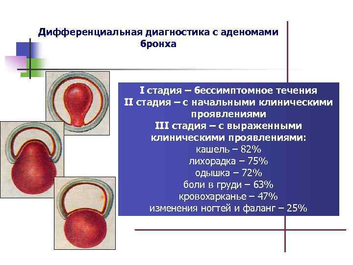 Дифференциальная диагностика с аденомами бронха I стадия – бессимптомное течения II стадия – с