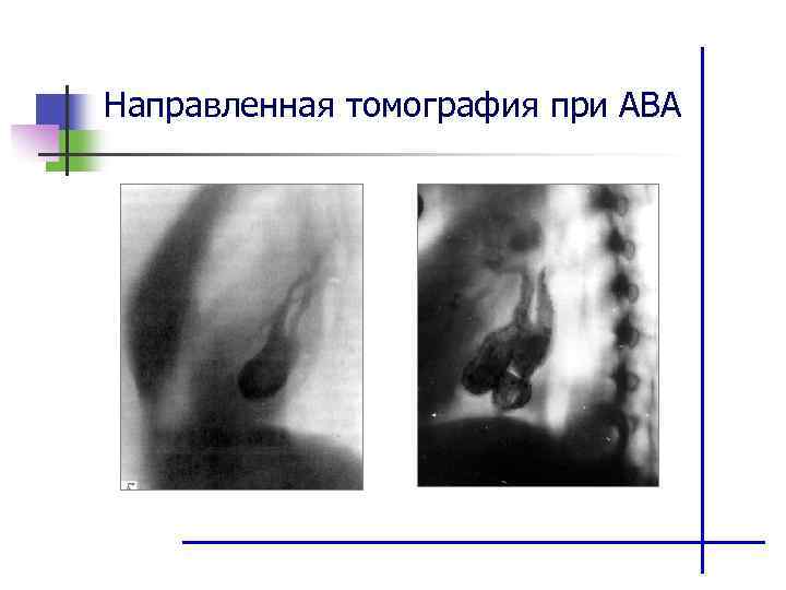 Направленная томография при АВА 