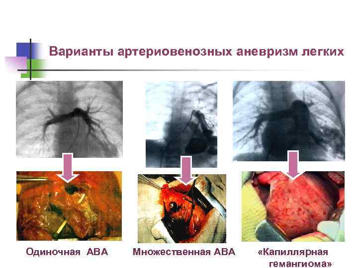 Варианты артериовенозных аневризм легких Oдиночная АВА Множественная АВА «Капиллярная гемангиома» “ 