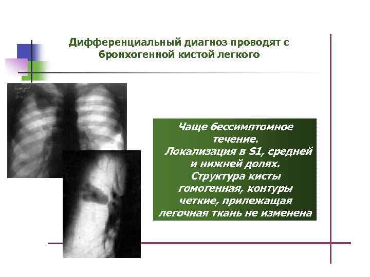 Дифференциальный диагноз проводят с бронхогенной кистой легкого Чаще бессимптомное течение. Локализация в S 1,