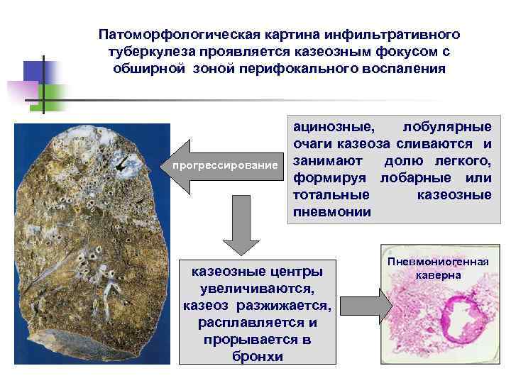 Туберкулез клинические рекомендации