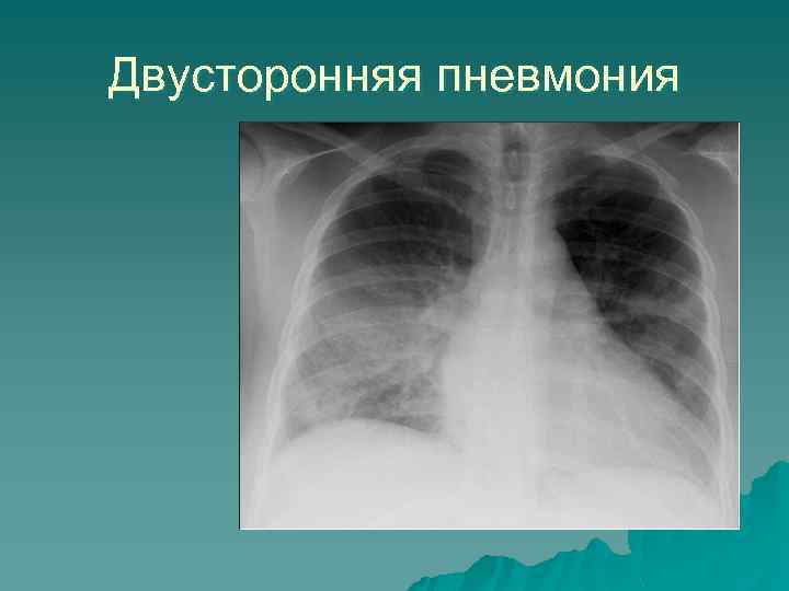 Двусторонняя пневмония 