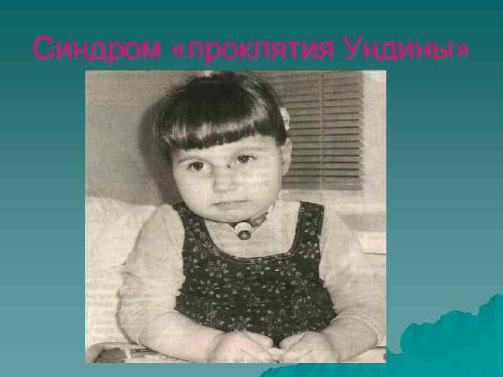 Синдром «проклятия Ундины» 