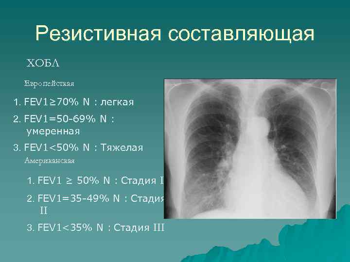 Резистивная составляющая ХОБЛ Европейсткая 1. FEV 1≥ 70% N : легкая 2. FEV 1=50
