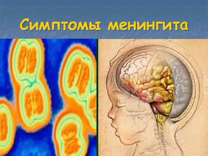 Симптомы менингита 