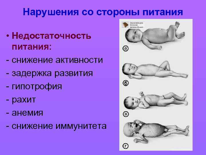 Нарушения со стороны питания • Недостаточность питания: - снижение активности - задержка развития -