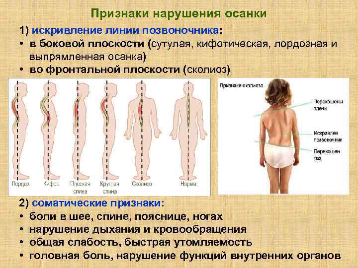 Рассмотрите рисунки 1 3 с изображением изменений осанки человека как называется нарушение осанки 3