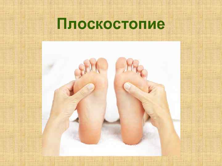 Плоскостопие 