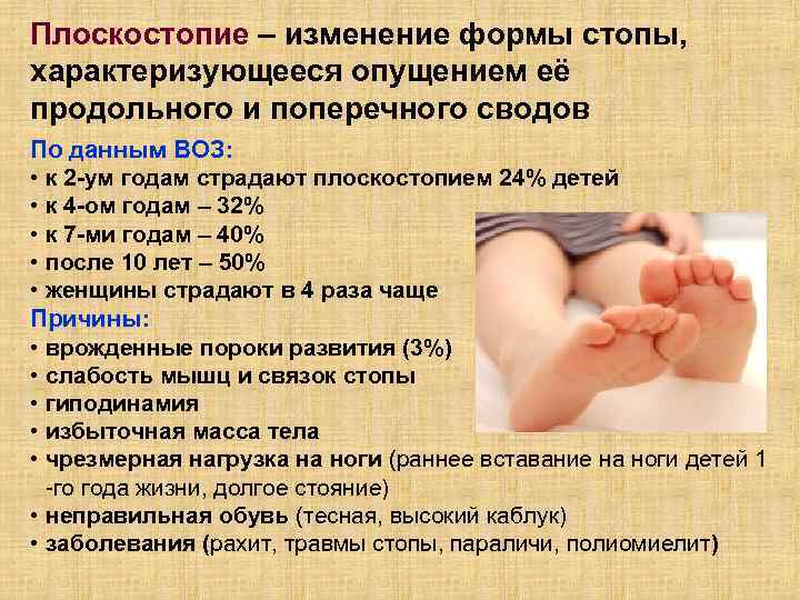 Плоскостопие – изменение формы стопы, характеризующееся опущением её продольного и поперечного сводов По данным