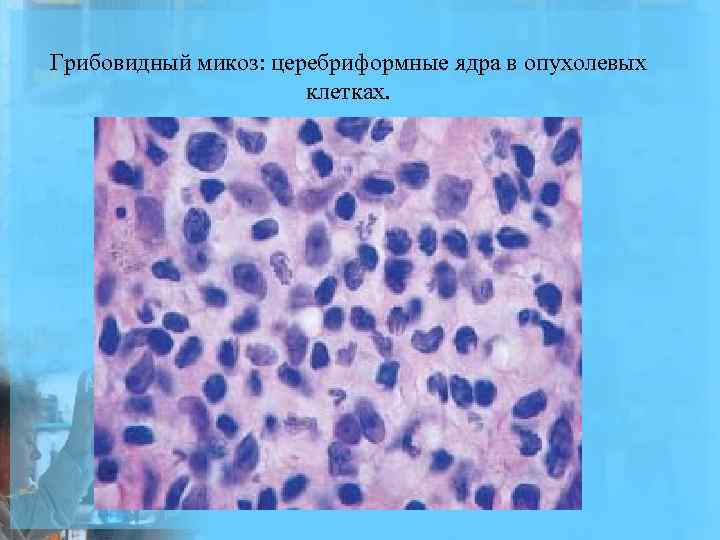 Грибовидный микоз: церебриформные ядра в опухолевых клетках. 