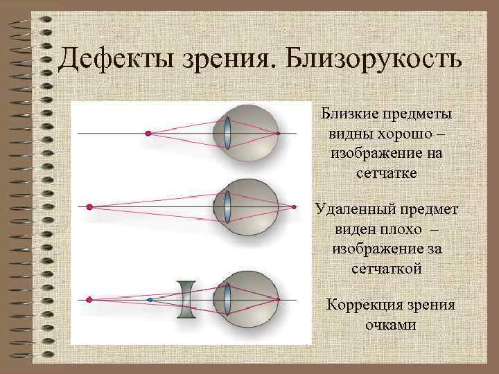 Дефекты зрения. Близорукость Близкие предметы видны хорошо – изображение на сетчатке Удаленный предмет виден