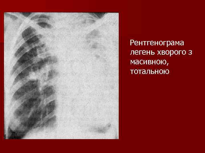 Рентгенограма легень хворого з масивною, тотальною 