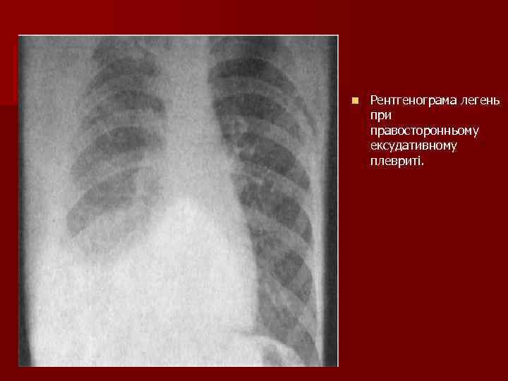n Рентгенограма легень при правосторонньому ексудативному плевриті. 