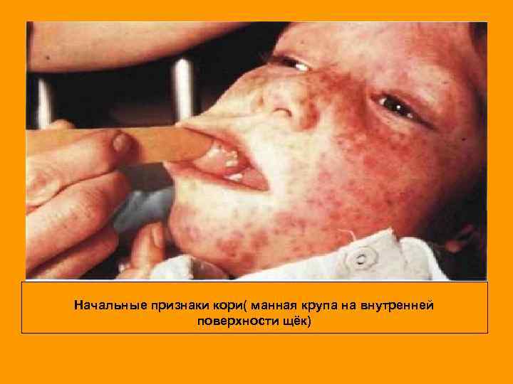 Начальные признаки кори( манная крупа на внутренней поверхности щёк) 