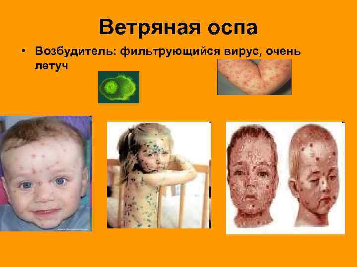 Ветряная оспа • Возбудитель: фильтрующийся вирус, очень летуч 