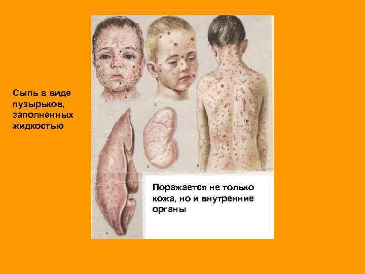 Сыпь в виде пузырьков, заполненных жидкостью Поражается не только кожа, но и внутренние органы