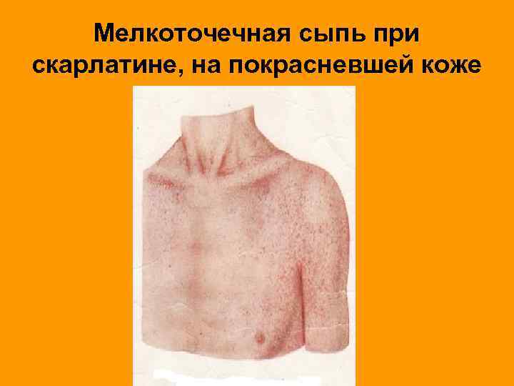 Мелкоточечная сыпь при скарлатине, на покрасневшей коже 