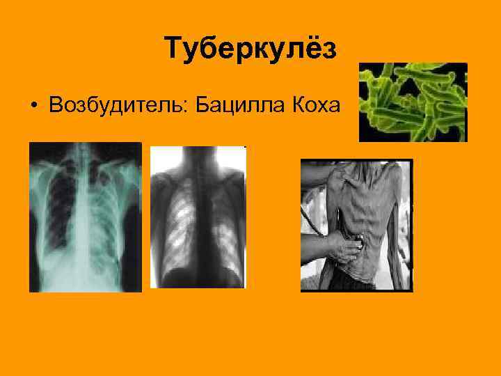 Туберкулёз • Возбудитель: Бацилла Коха 