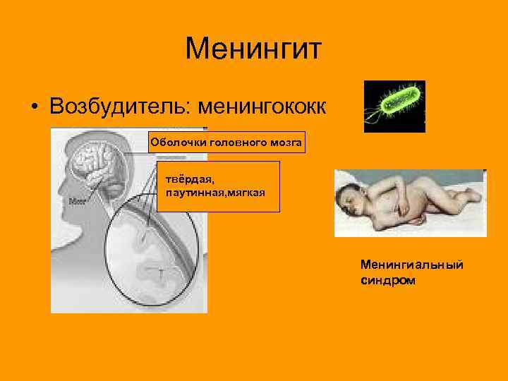 Менингит • Возбудитель: менингококк Оболочки головного мозга твёрдая, паутинная, мягкая Менингиальный синдром 