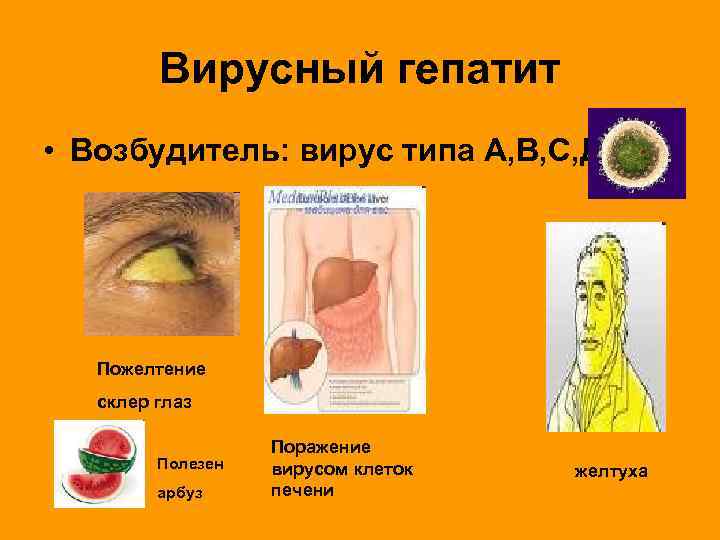 Вирусный гепатит • Возбудитель: вирус типа А, B, С, Д Пожелтение склер глаз Полезен