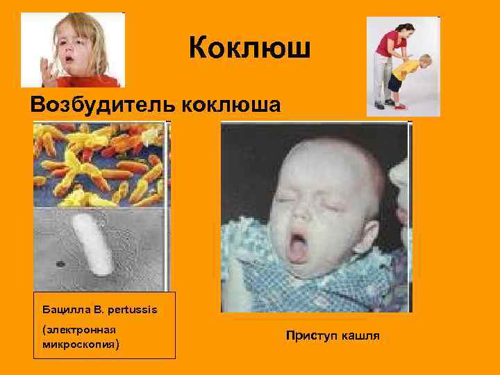 Коклюш Возбудитель коклюша Бацилла B. pertussis (электронная микроскопия) Приступ кашля 